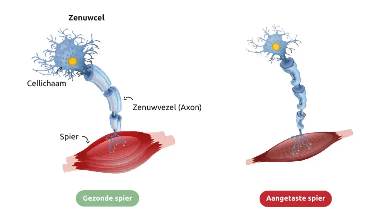 Illustratie van een gezonde spier en een spier met ALS