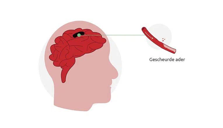 Een gescheurd bloedvat is de oorzaak van een hersenbloeding.