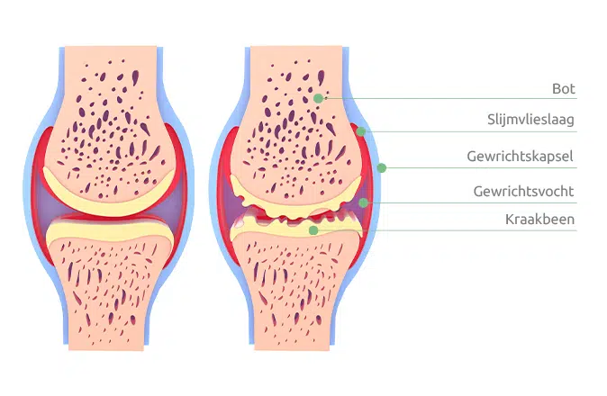 Een schematische afbeelding van een gezonde knie en van een knie met artrose.