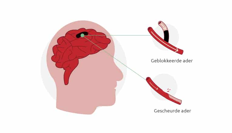 Wat de oorzaken zijn van een beroerte: een herseninfarct of een hersenbloeding.