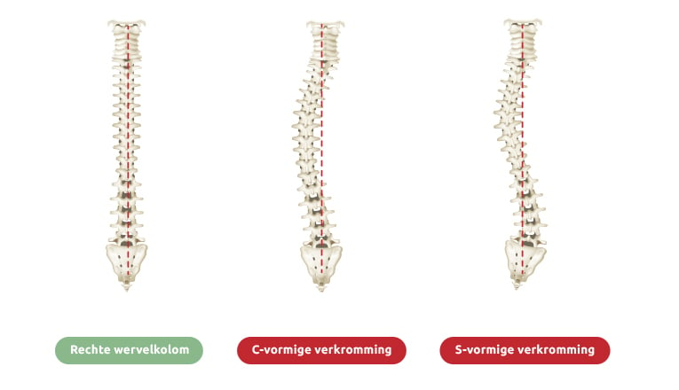 Een rugwervel in normale, rechte stand, en door scoliose aangetaste wervels in C-vorm en S-vorm laten duidelijk zien hoe scoliose verschillende lichamelijke symptomen kan veroorzaken.