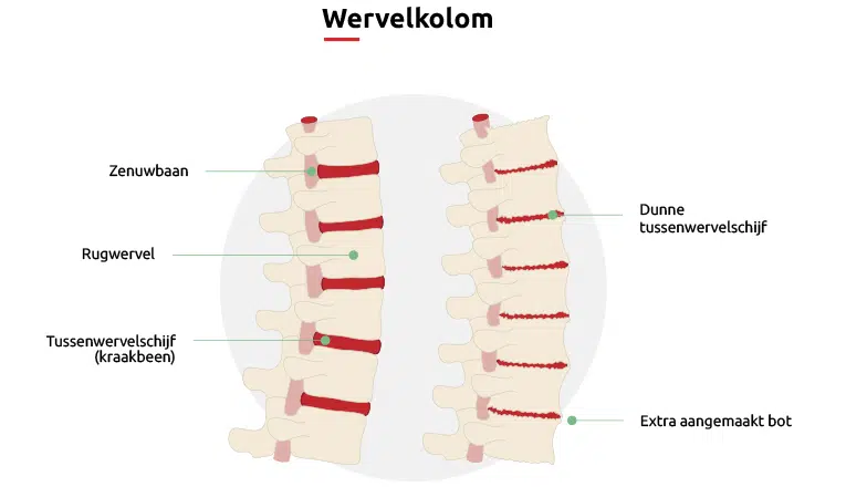 Een schematische weergave van ‘Wat is artrose in de rug’.