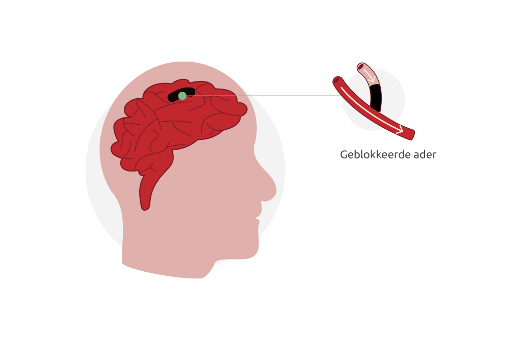 Een herseninfarct ontstaat als een (slag)ader in de hersenen wordt geblokkeerd.