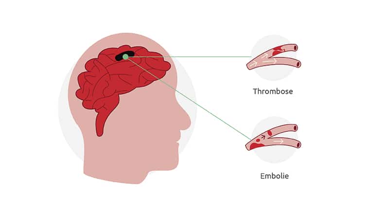 Un AIT est un léger accident vasculaire cérébral provoqué par l'interruption temporaire de l’apport sanguin au cerveau.