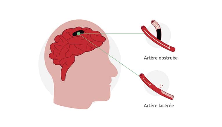 L’illustration montre les causes d’une attaque : un infarctus cérébral ou une hémorragie cérébrale.