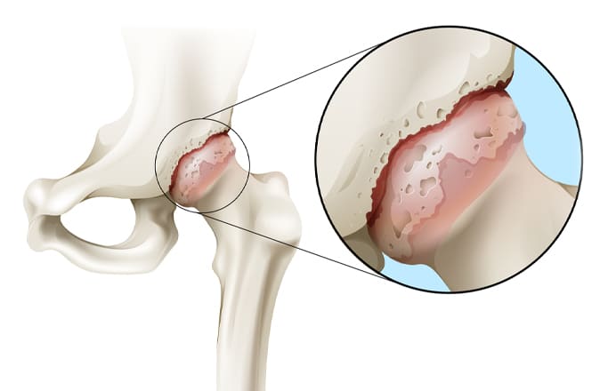 Une représentation schématique de l'arthrose de la hanche : une hanche atteinte par l'arthrose.