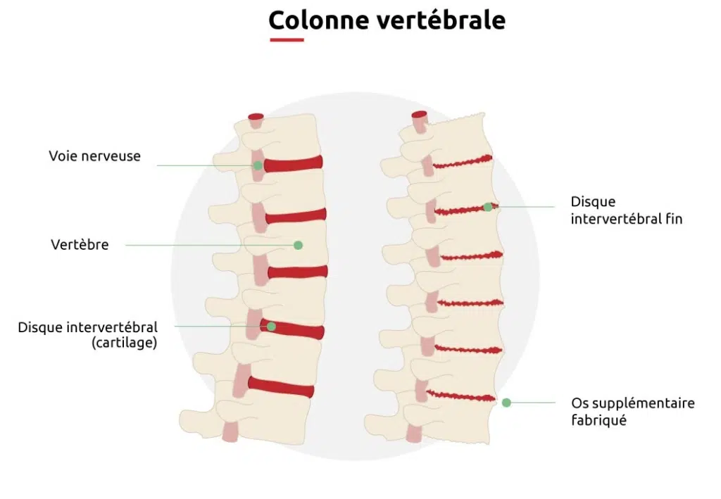 Une représentation schématique de 'Qu'est-ce que l'arthrose du dos'.