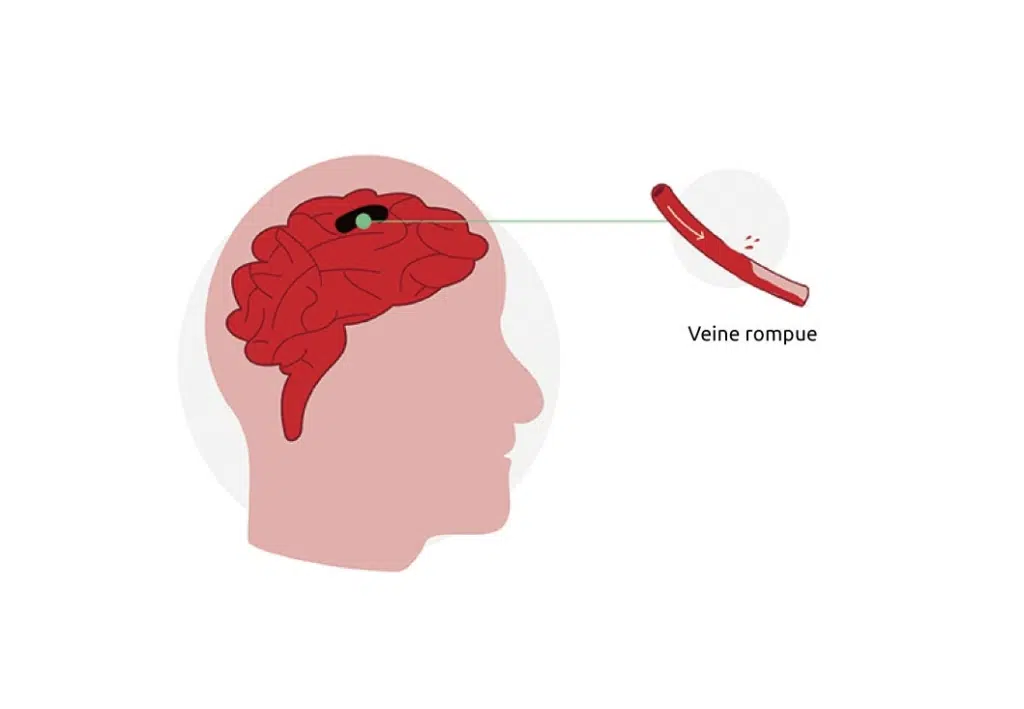 La rupture vasculaire est la cause d'une hémorragie cérébrale