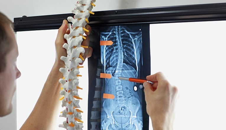 Un médecin montre une vertèbre dorsale en position normale et une radiographie d'une vertèbre dorsale d'un adulte atteint de scoliose.