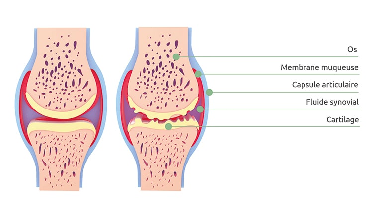 Une image schématique d'un genou souffrant d'arthrose et d'un genou sain