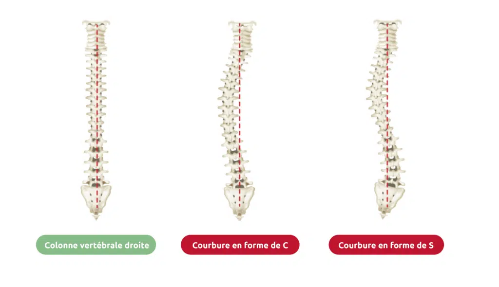 Une vertèbre dorsale normale droite et des vertèbres atteintes par la scoliose de forme c et de forme S montrent clairement comment la scoliose peut causer différents symptômes physiques.